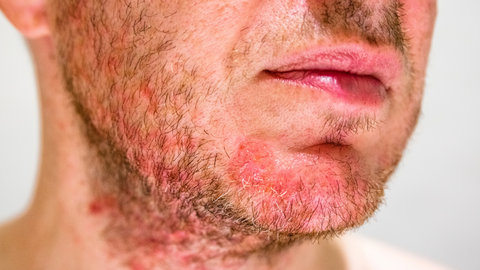 seborrheic dermatitis on the face