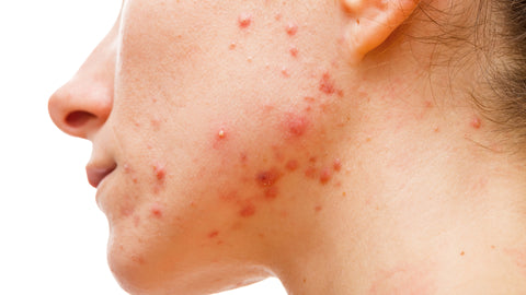 acne breakout from stress