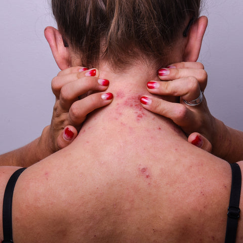 how acne affects mental health