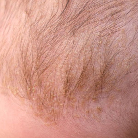 Cradle cap on an infants scalp