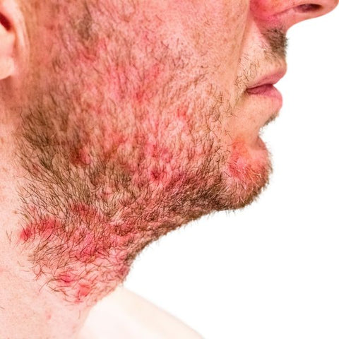 seborrheic dermatitis around the face and neck