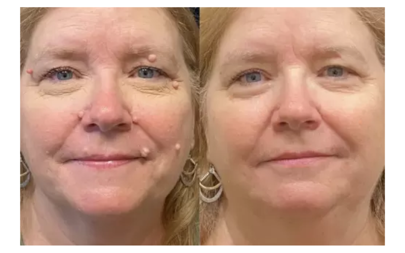Bikenda® SpotlessDerm Mole and Wart Laser Pen