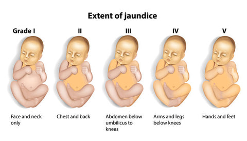 Dealing with Infant Jaundice: A Parent's Guide