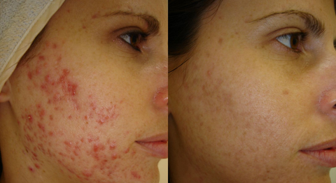 Before After Red Light Therapy Treatment for Acne