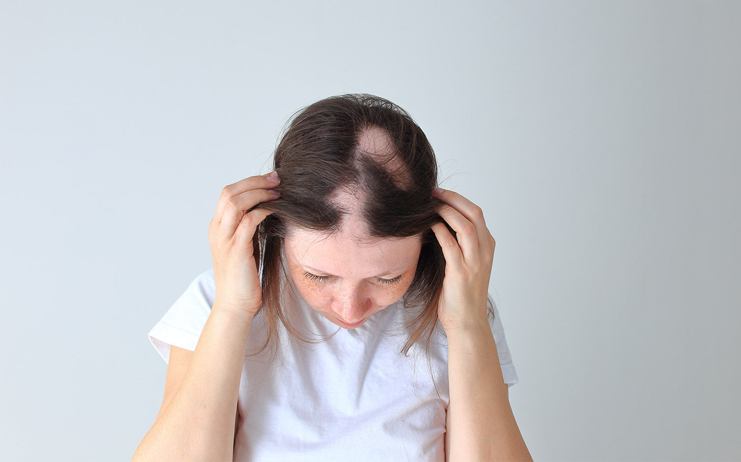 Alopecia-Blog