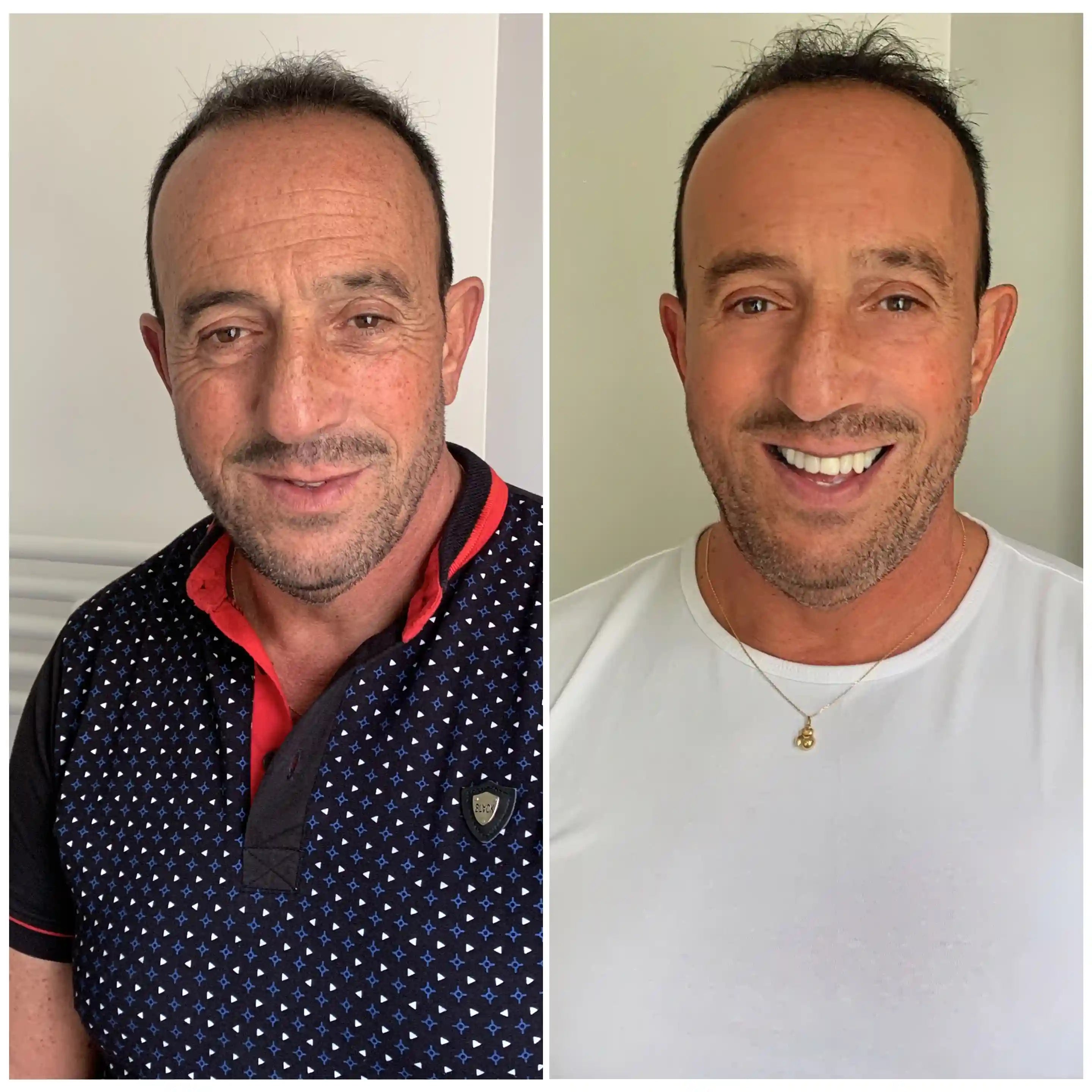 Side-by-side comparison of a man before and after cosmetic improvements, smiling in the after photo.