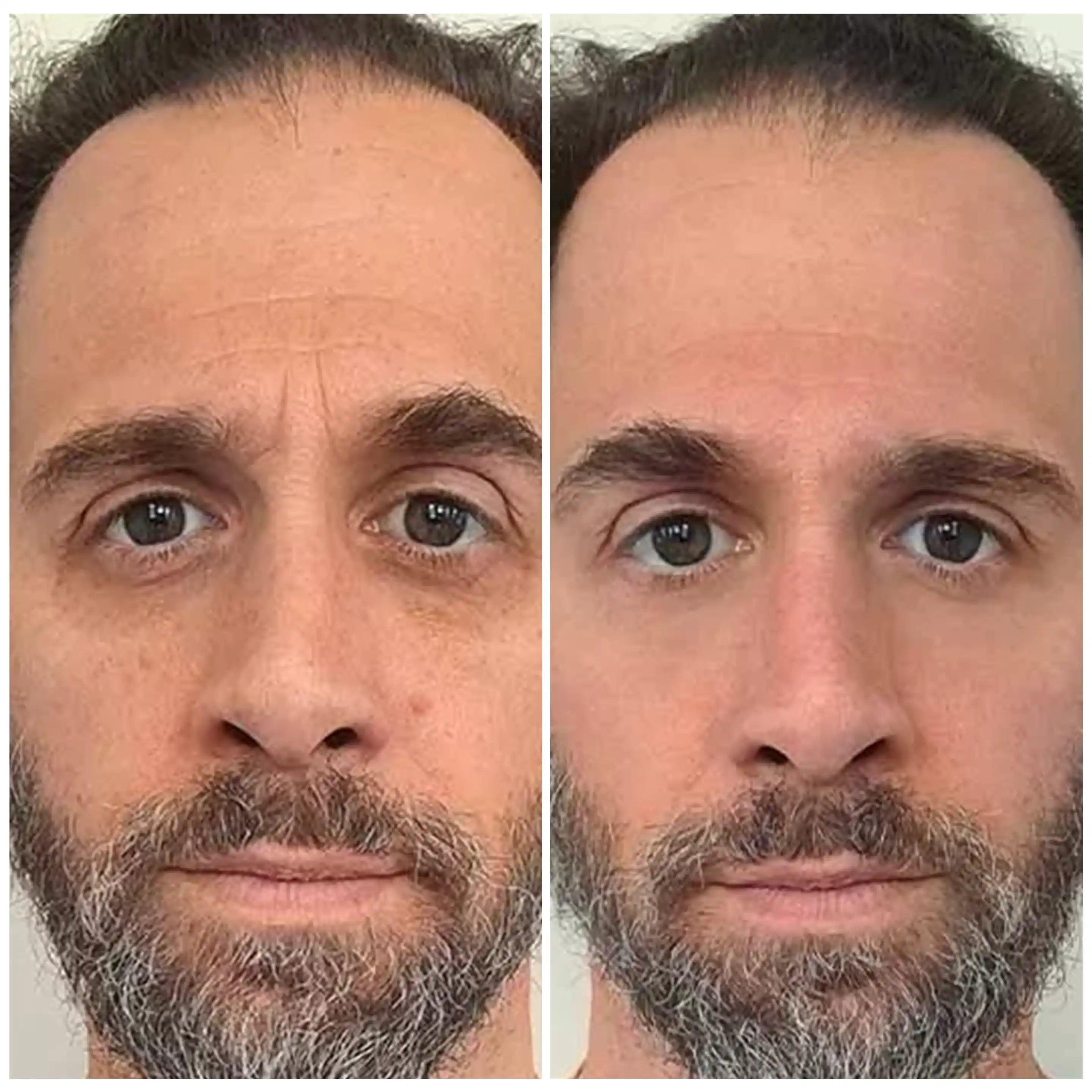 Before and after image showing a man's face undergoing facial improvements.