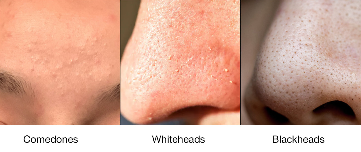 Image of Blackheads, whiteheads and comedones