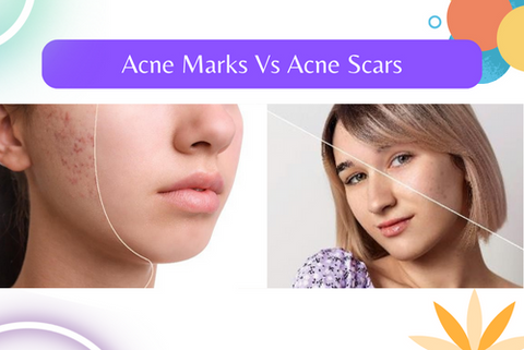 two girls demonstrate difference between acne scars vs acne marks