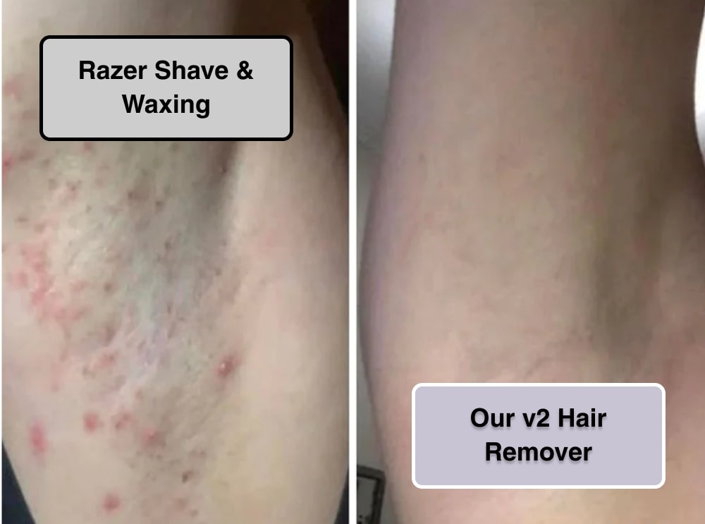 7 Hair Removal Methods for Smooth, Hairless Skin