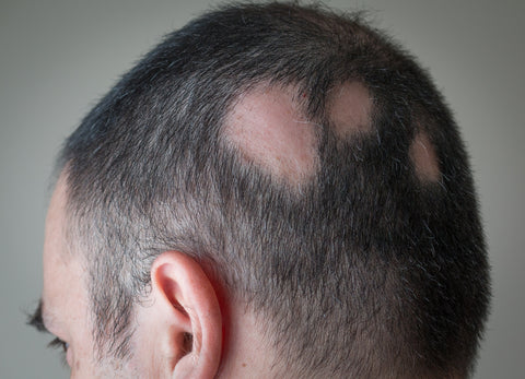 Photograph of a scalp with bald spots caused by ringworm, illustrating the impact of tinea capitis.