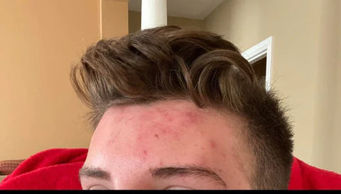 Image showing red bumps and irritation on the forehead, depicting Acne Mechanica