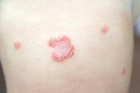 Close-up of impetigo symptoms showing red sores and honey-colored crusts on skin.