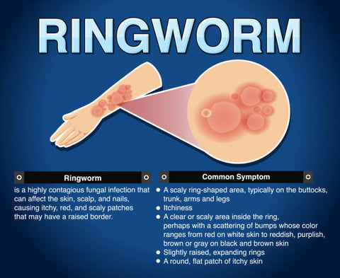 Informative infographic detailing ringworm causes, symptoms, and treatments, with a focus on 'how do you get a ringworm rash' and 'what do you treat ringworm with'