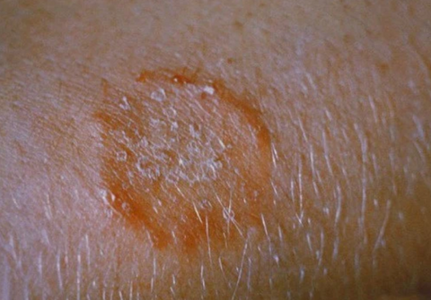 Healing ringworm rash on leg with reduced redness and clearer skin texture, illustrating how do you know when ringworm is healing.