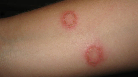 Illustration depicting the fungus that causes ringworm, highlighting its presence on human skin.