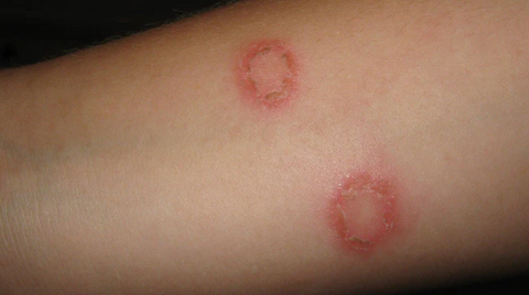 Close-up image of ringworm rash on human arm, showcasing the typical red, circular pattern, helping readers understand how do you get a ringworm rash.