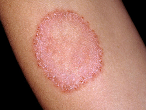 What Is Ringworm? Symptoms, Causes, Diagnosis, Treatment, and Prevention