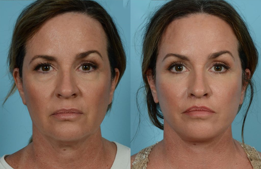 microcurrent facial