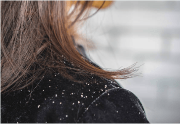 Signs of Dandruff