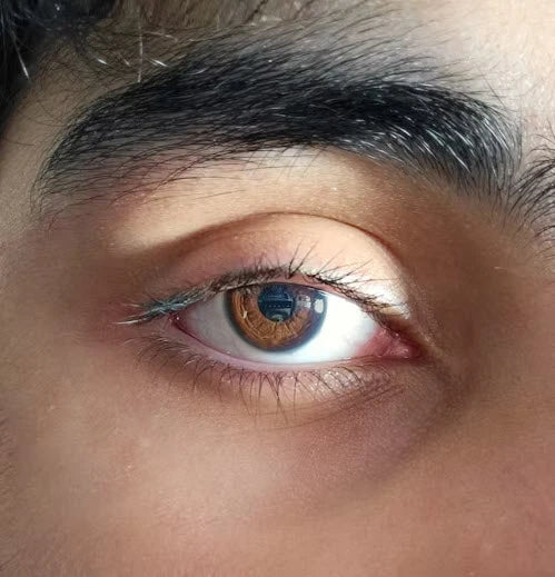 The eye close-up with redness