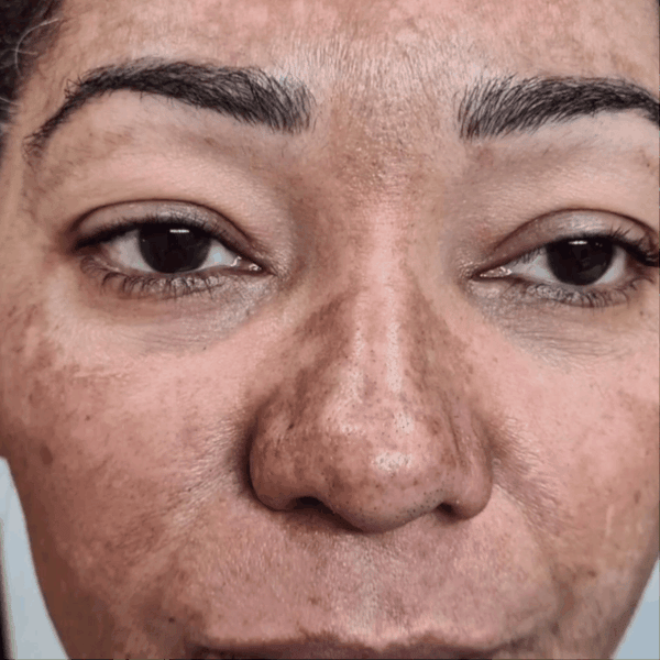 100Melasma | 2 frascos 2