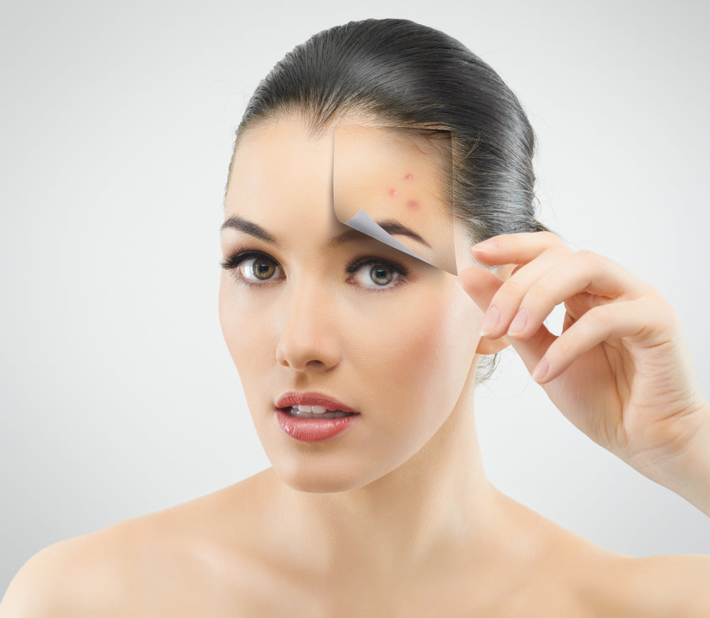 A woman with and without an acne on her forehead