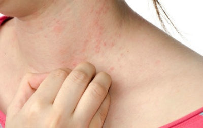 A woman with keratosis pilaris on her neck