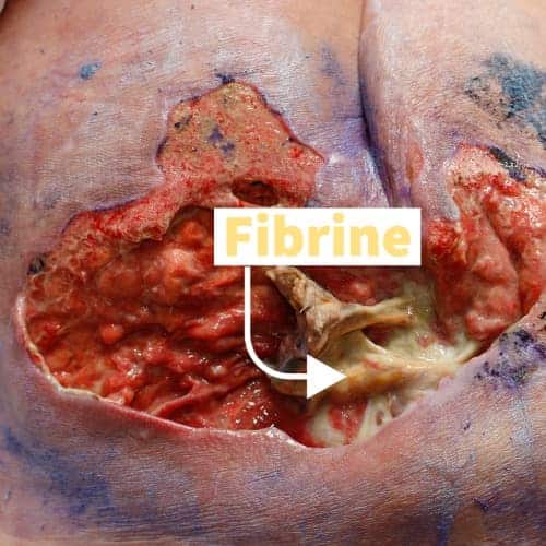 Fibrin on a pressure sore wound