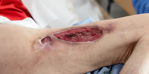 Photo of a stage 3 pressure ulcer in a diabetic patient