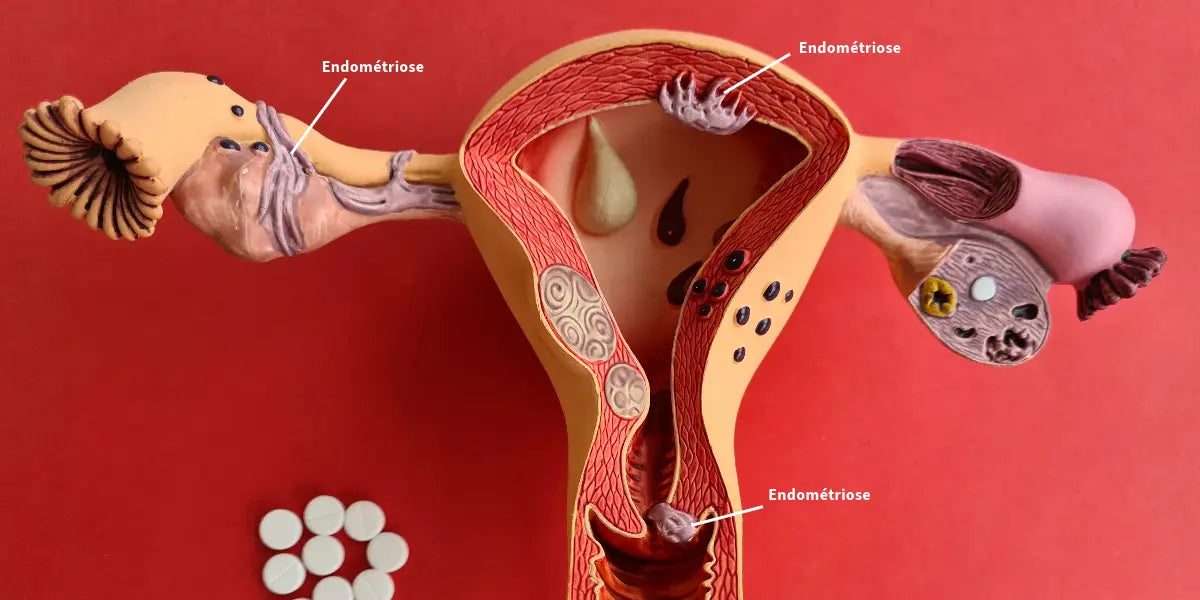 Endometriosis symptoms? Treatments and diet changes