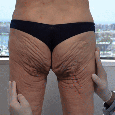 BuildLeaf® GLP-1 Nano-Microneedle Patch