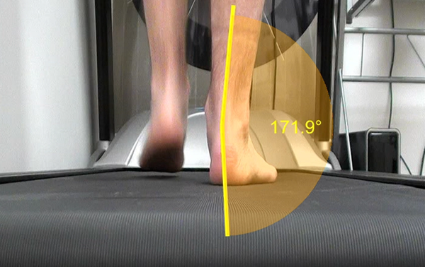 Excessive pronation affects the entire body when you walk or run.