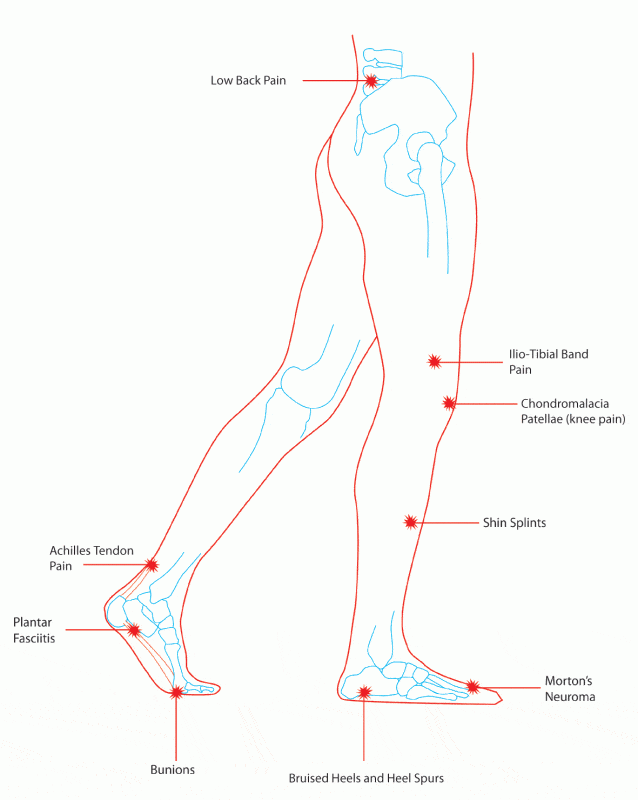 Plantar fasciitis sufferers can possess a range of different abnormalities in the lower body