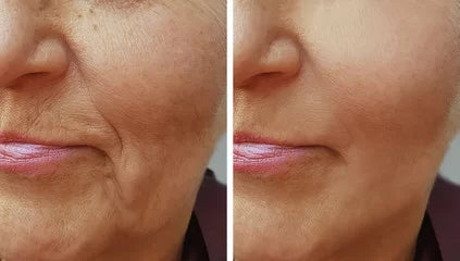 anti age lumière pulsée IPL