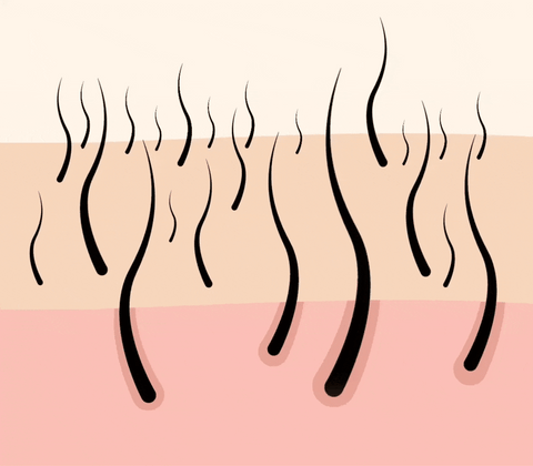 IPL hair removal pulsed light hair removal