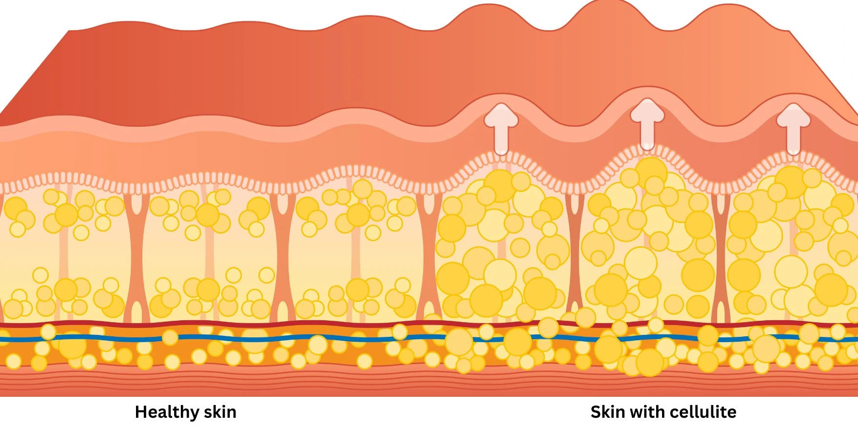 Cellulite