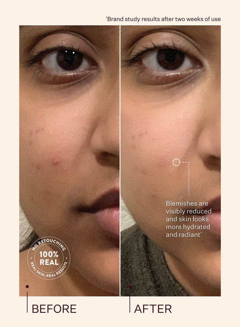 A before and after comparison of someone using Travel Size Glass Skin Refining Serum where the after image clearly shows the blemishes are visibly reduced and the skin looks more hydrated and radiant after two weeks