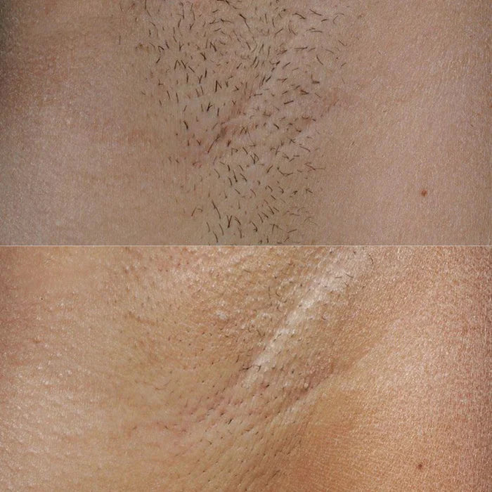 Close-up comparison of underarm hair before and after treatment.