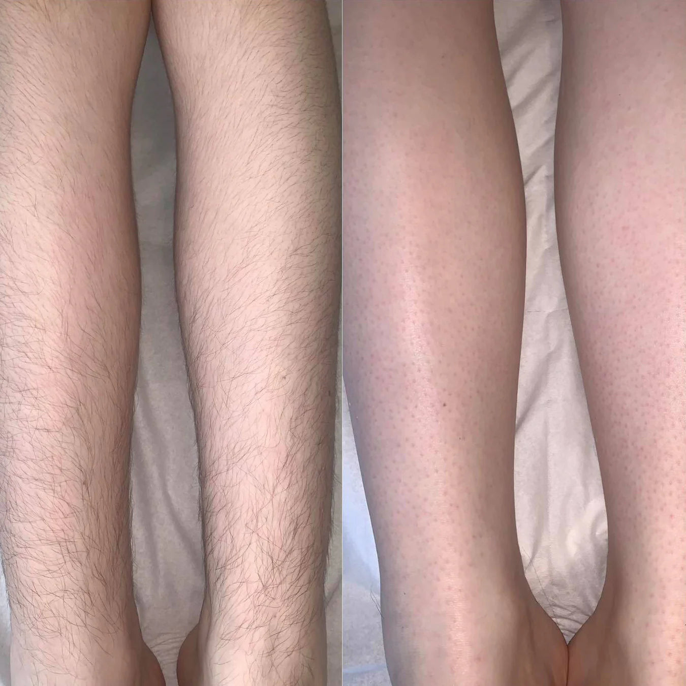 Comparison of legs before and after hair removal treatment.