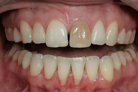Precio blanqueamiento dental VitalDent