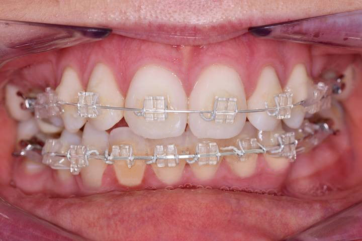 Braces for Adults, Braces in West Midlands
