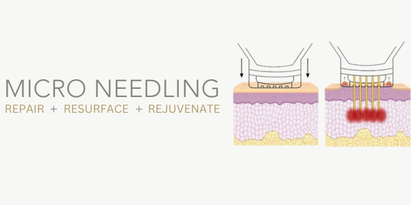 LUMNI -MICRONEEDLING.png__PID:f571a315-2ca4-40b6-b523-487242bf7eda