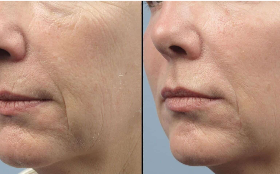 Collagen Loss