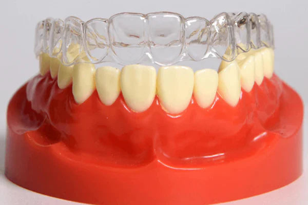 Une image d'aligneurs transparents sur un modèle de dents