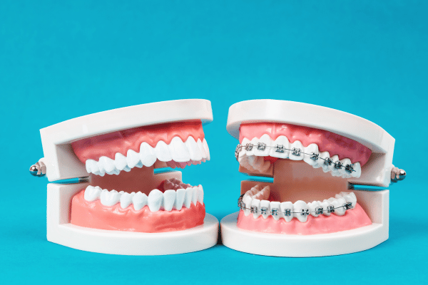  Dental Braces for Comparison