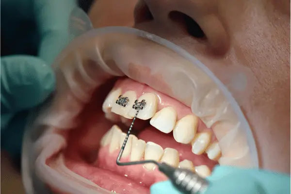 Metal braces for misaligned teeth