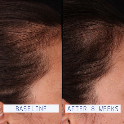 Hair Density Boosting Treatment Results