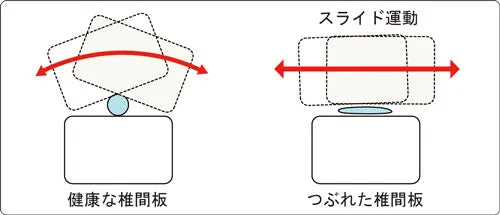 健康な椎間板・つぶれた椎間板