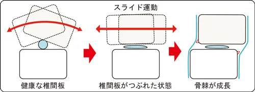 変形性腰椎症の腰痛の原因